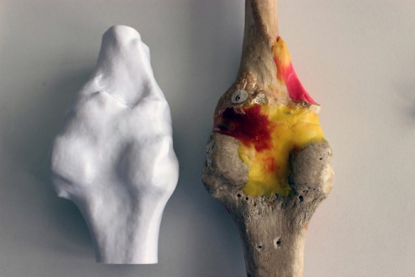 Протез коленного сустава создали в ФабЛабе ТюмГУ 