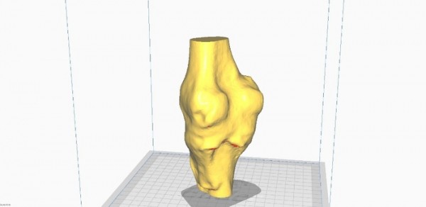 В Тюмени создали протез коленного сустава по технологии будущего 