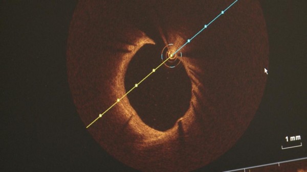 Тюменцы поделятся опытом исследований коронарной артерии 