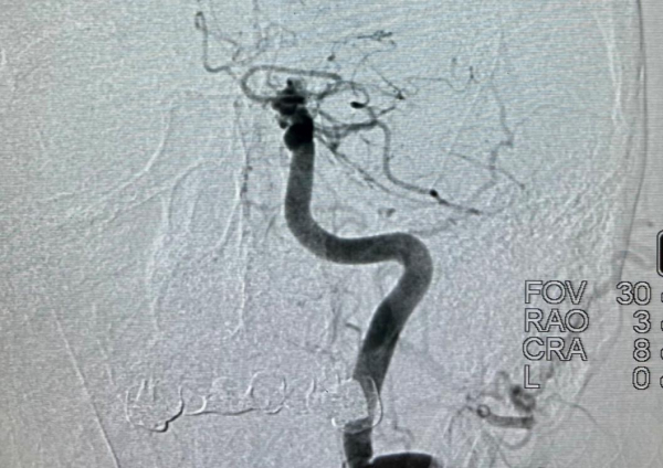 Тобольские врачи извлекли из сосуда головного мозга пациента четырехсантиметровый тромб 
